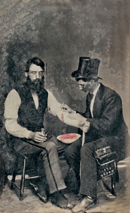 The first ever photo of bloodletting